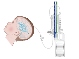 External ventricular drain-14